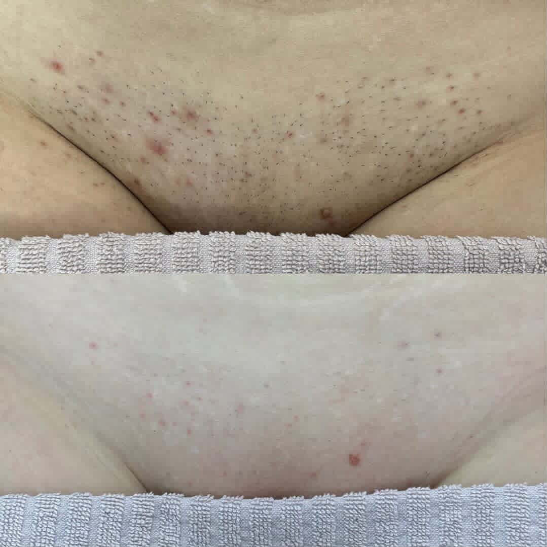 progress photos of Brazilian laser hair removal before and after