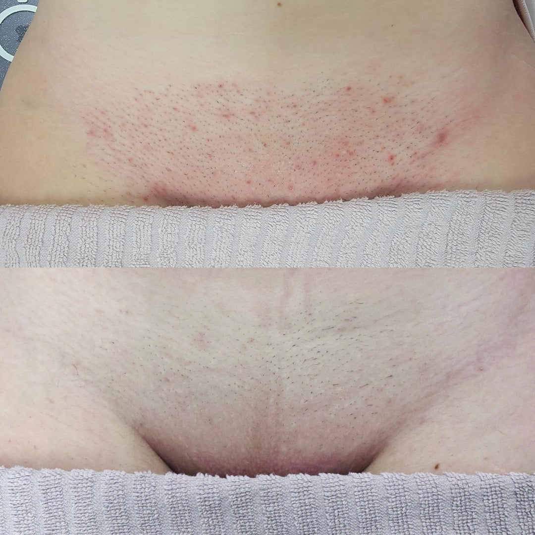 progress comparison of Brazilian laser hair removal