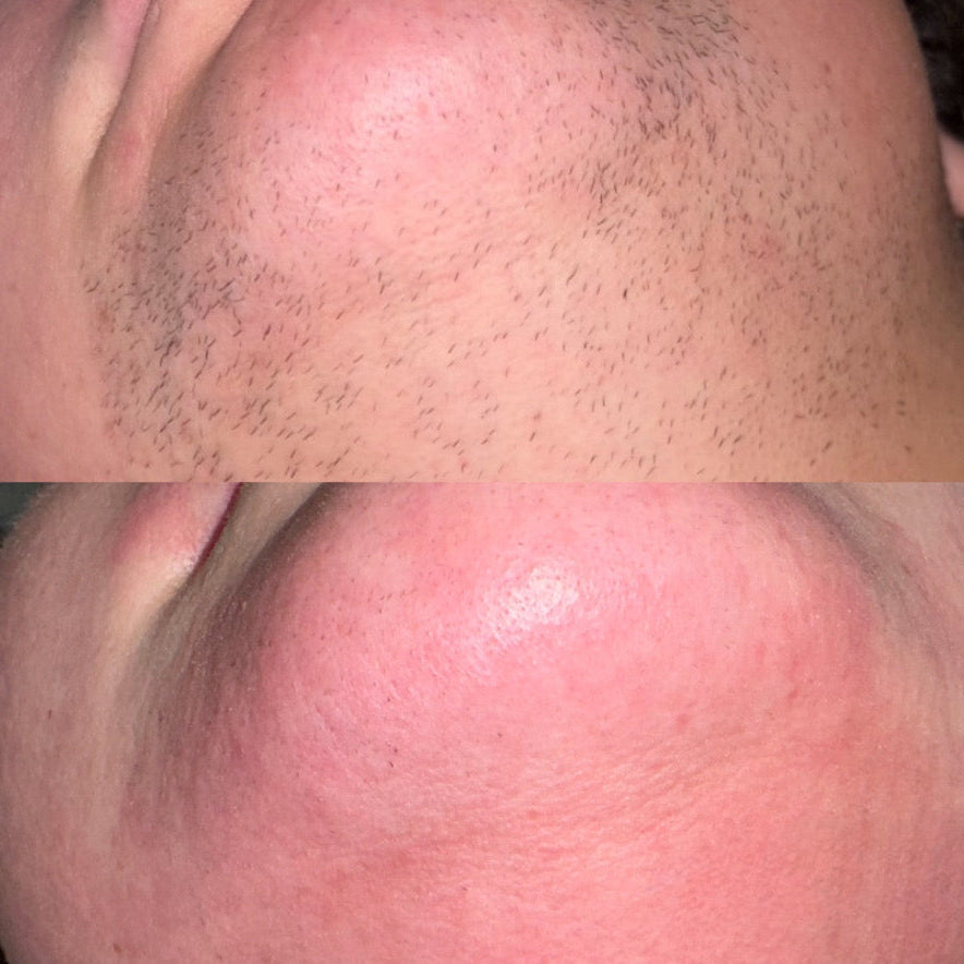 Before and after comparison of a chin with hair removal on the top and smooth skin on the bottom.